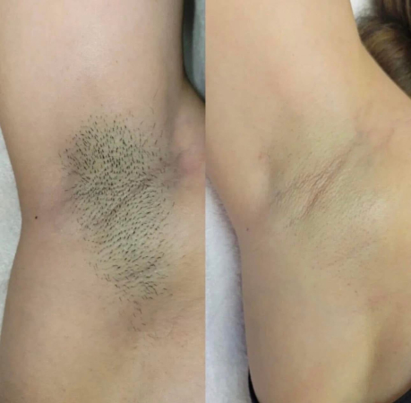 laser-hair-removal